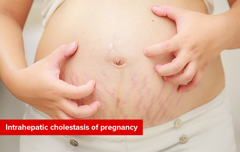 Kolestasis Intrahepatik pada Kehamilan
